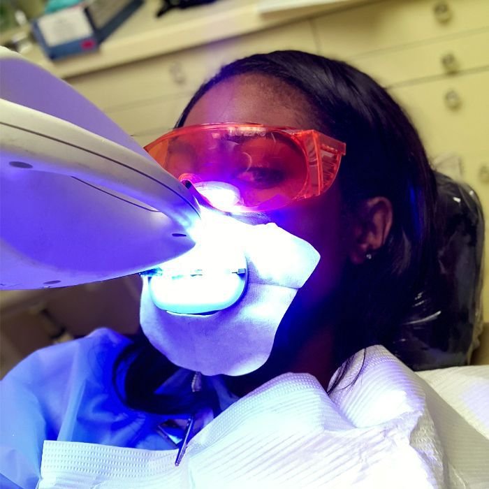 Are There Any Side Effects Of Laser Teeth Whitening?