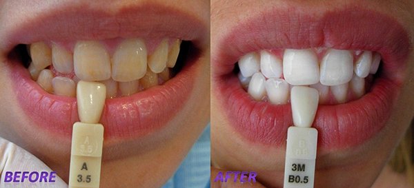 Are There Any Side Effects Of Laser Teeth Whitening?