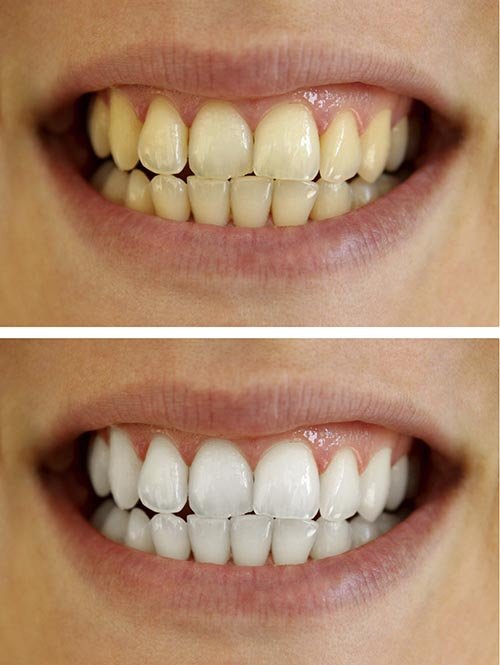 Can I Get Teeth Whitening If I Have Thin Enamel?
