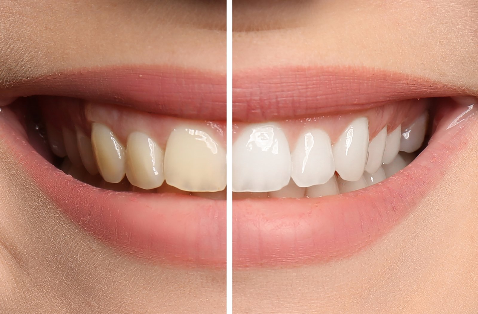 Can I Whiten My Teeth If I Have A History Of Sensitive Teeth?