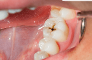 Can I Whiten My Teeth If I Have Cavities?