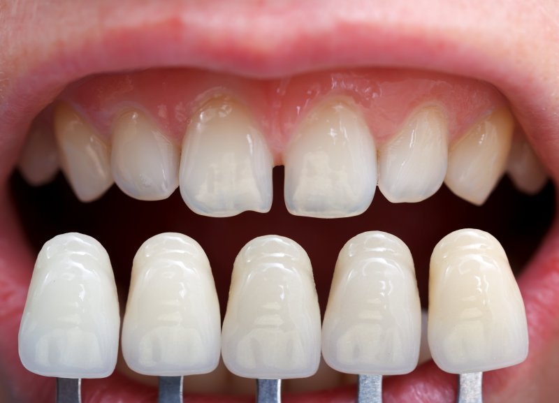 Can I Whiten My Teeth If I Have Dental Veneers?