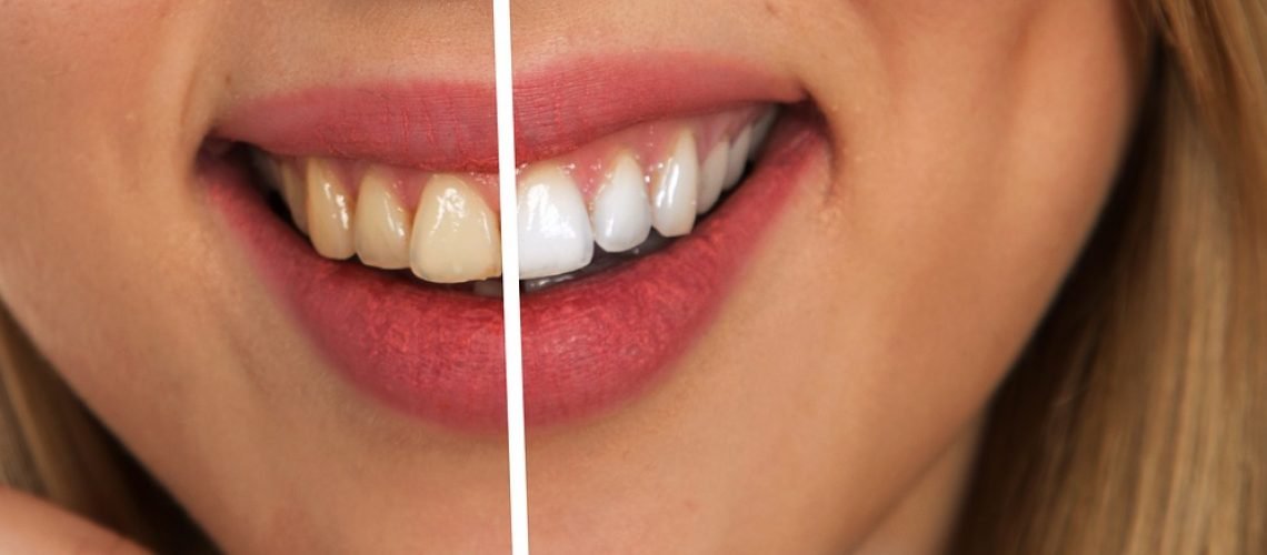 Can Medication Affect The Results Of Teeth Whitening?