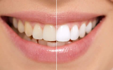 Can Smoking Affect Teeth Whitening Results?