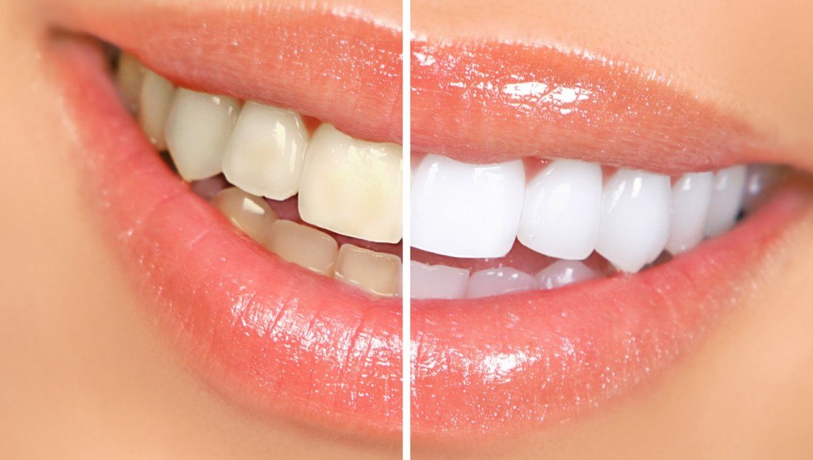 Does Insurance Cover The Cost Of Teeth Whitening?