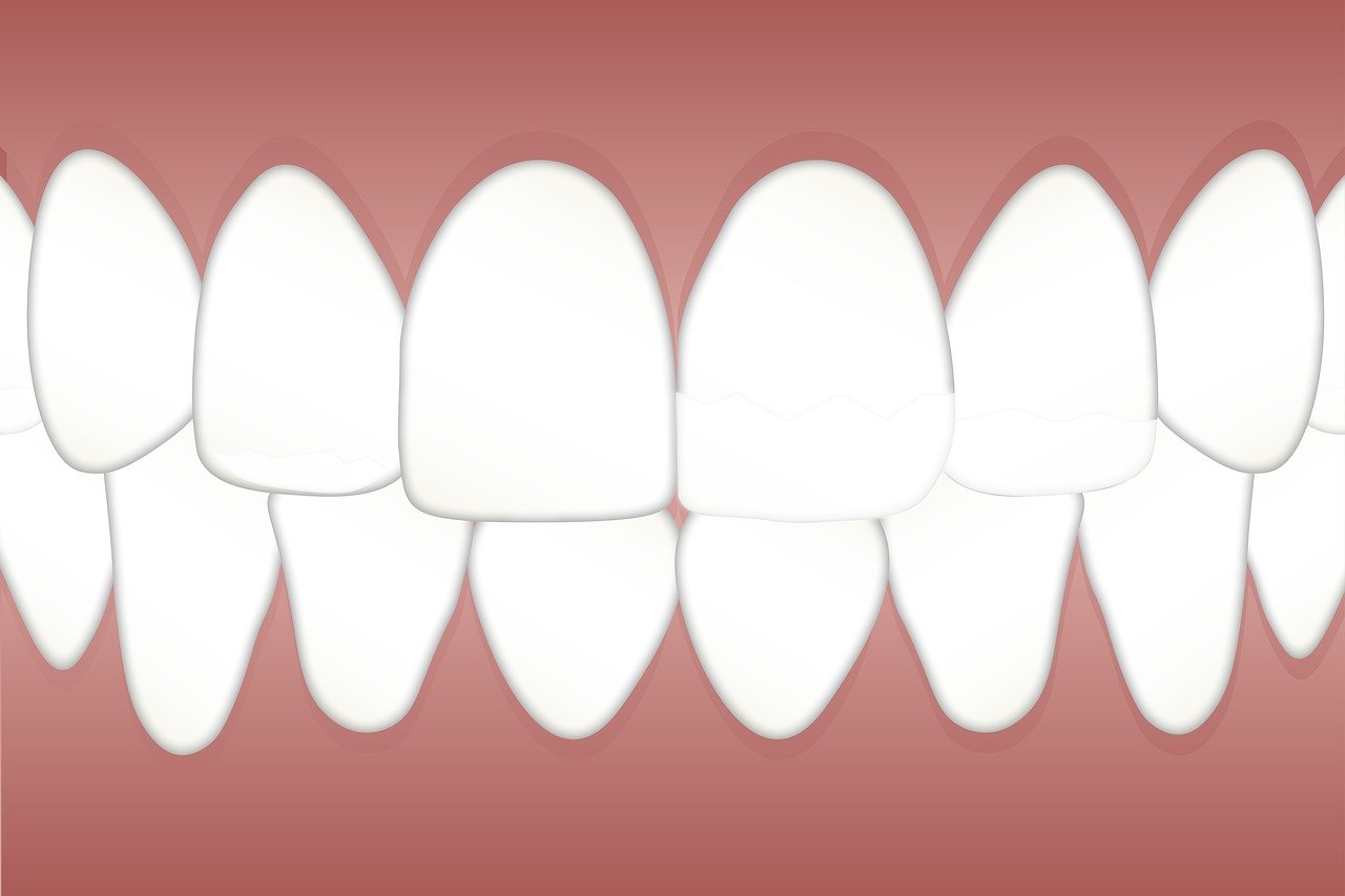 Does Teeth Whitening Improve Oral Health Apart From Appearance?