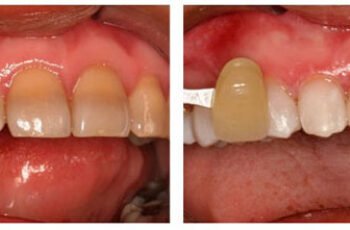 Does Teeth Whitening Work On Tetracycline-stained Teeth?