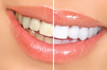 How Can I Maintain My White Teeth After Treatment?