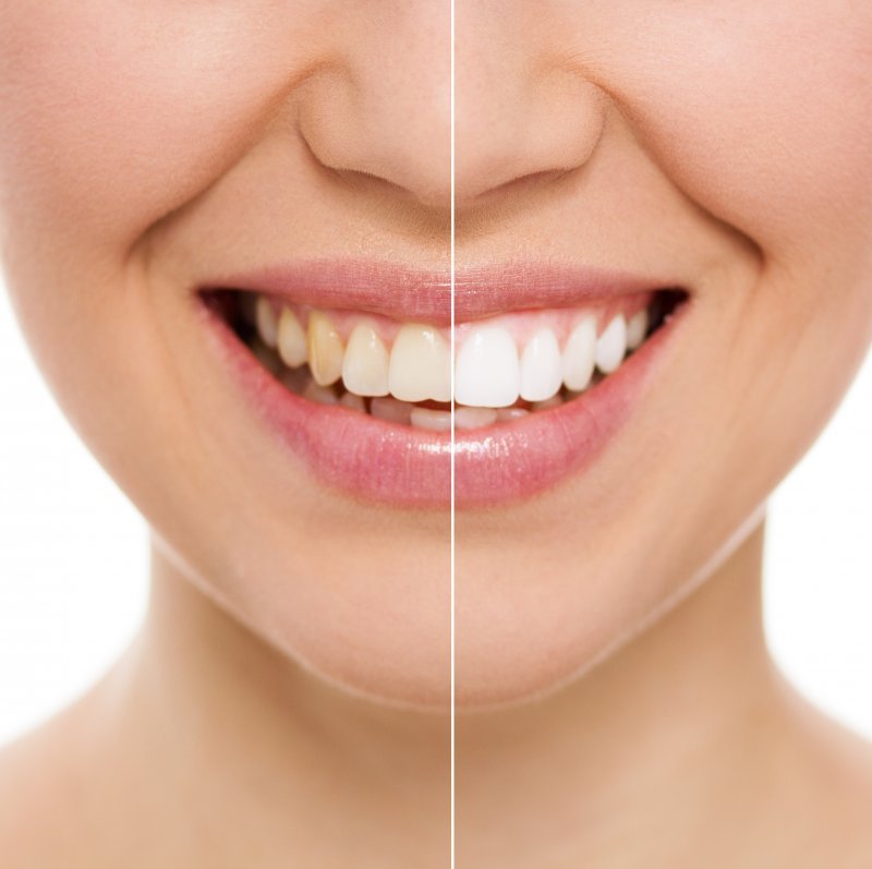 How Do I Avoid Overusing Teeth Whitening Products?