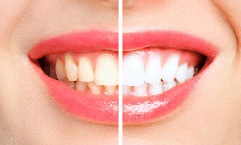 How Do I Avoid Overusing Teeth Whitening Products?