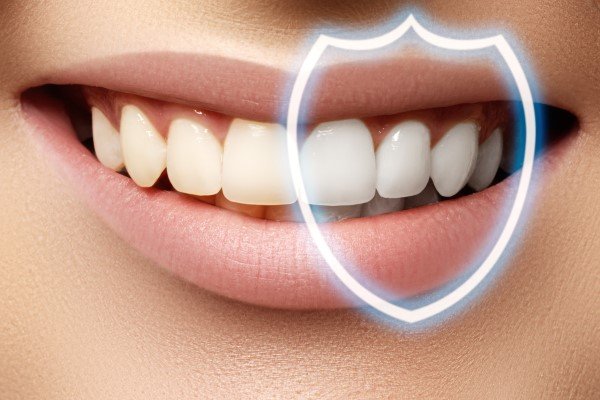 How Do I Prepare For A Teeth Whitening Procedure?