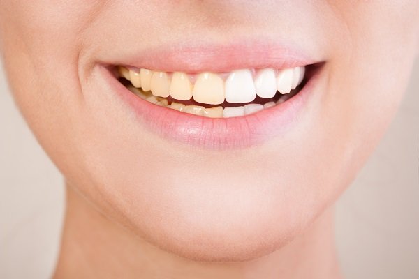How Does Age Impact The Effectiveness Of Teeth Whitening?