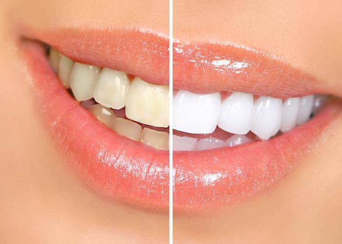 How Does Age Impact The Effectiveness Of Teeth Whitening?