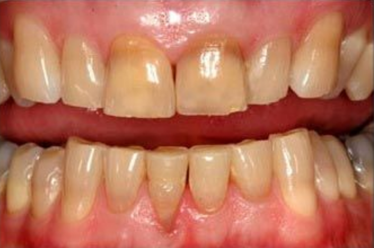 How Does Diet Influence Teeth Discoloration?