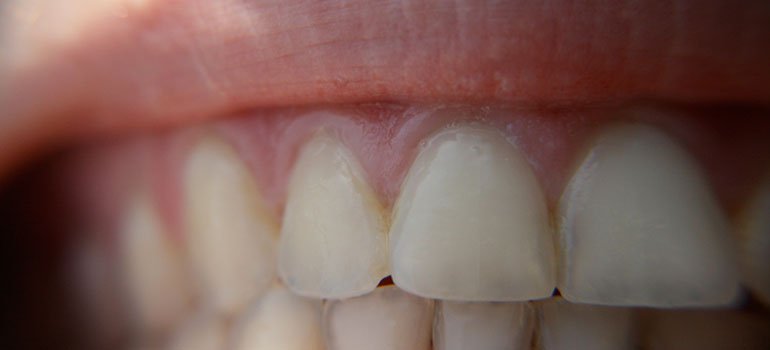 How Does Enamel Affect Teeth Sensitivity During Whitening?