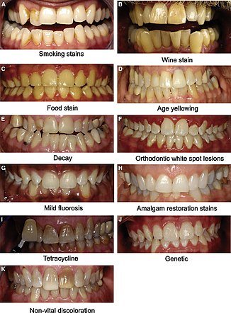 How Does The Natural Color Of Teeth Affect Whitening Outcomes?