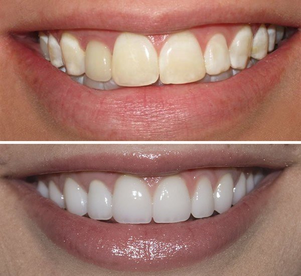 How Long Does Laser Teeth Whitening Take?