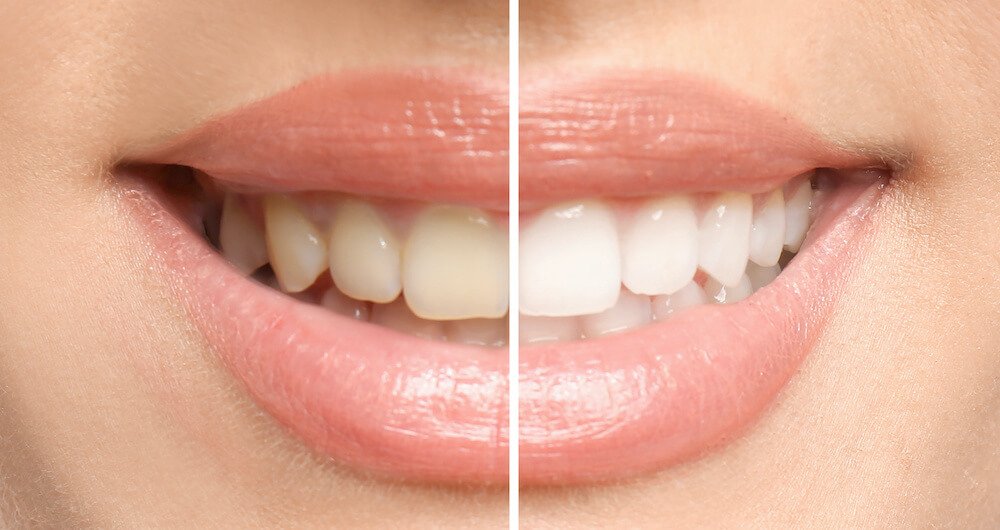 Is Teeth Sensitivity A Common Side Effect Of Whitening?