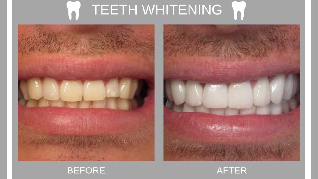 Is Teeth Whitening A Permanent Solution?