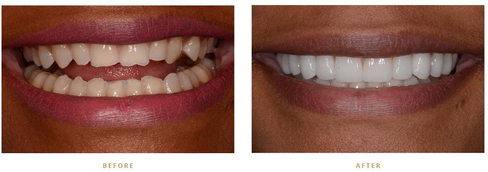 Is Teeth Whitening A Permanent Solution?