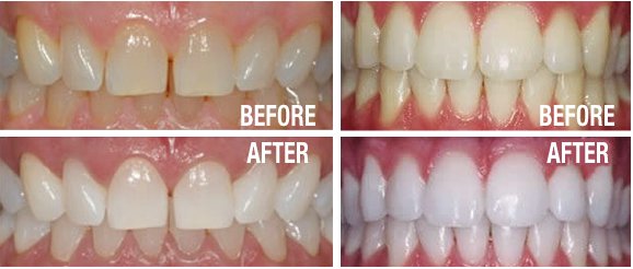 Is Teeth Whitening The Same As Teeth Bleaching?