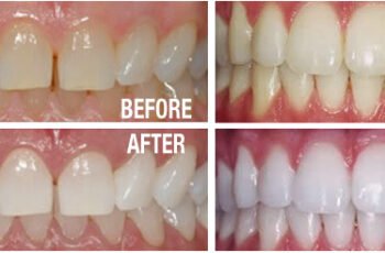 Is Teeth Whitening The Same As Teeth Bleaching?