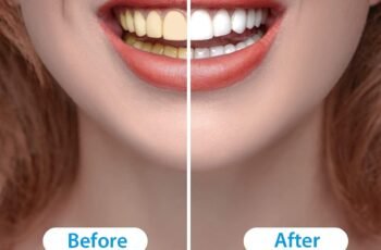MySmile Teeth Whitening Kit Enhanced Teeth Whitener Flagship Version Review