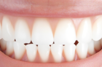 The Difference Between Laser Teeth Whitening and Bleaching