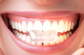 Top 10 Affordable Teeth Whitening Kits