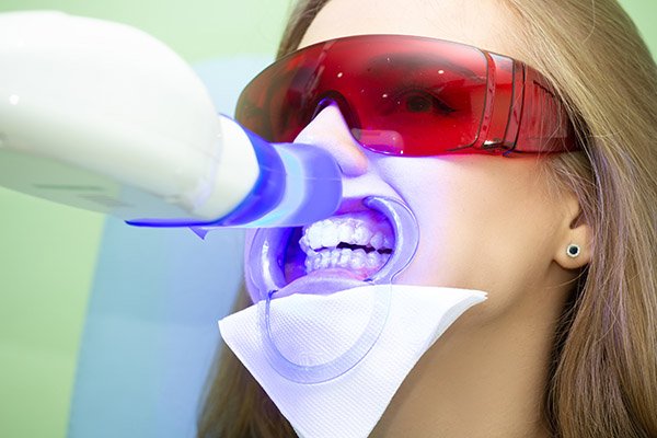 What Is Laser Teeth Whitening?