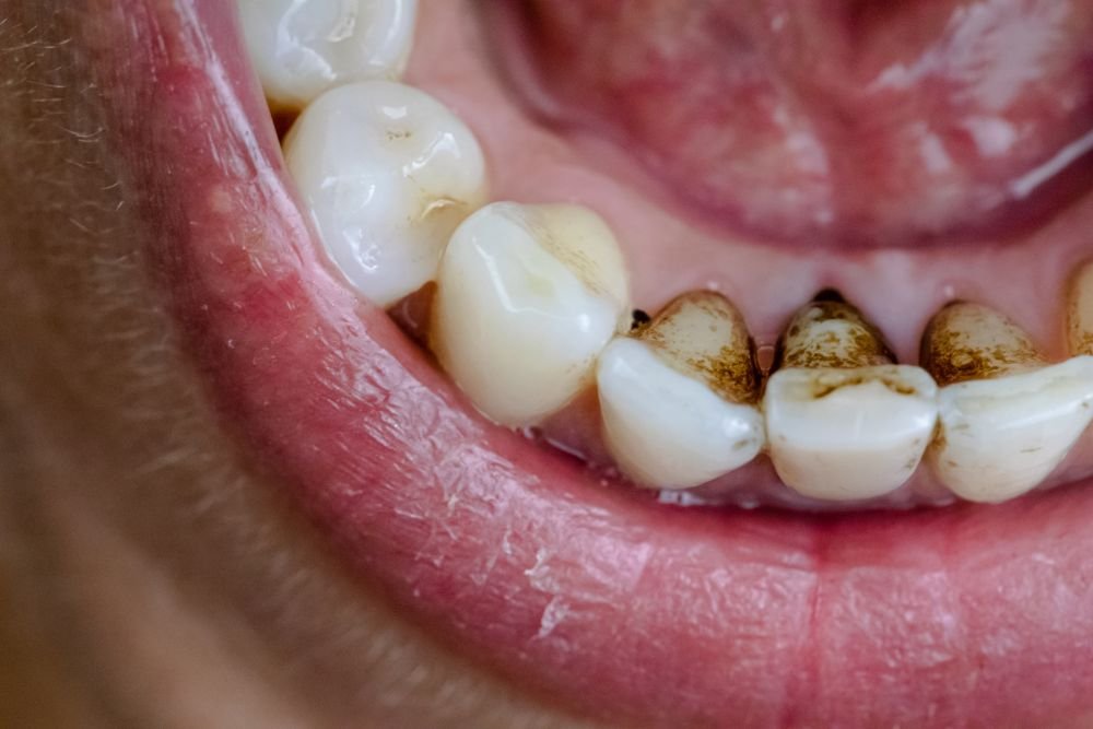 What Is The Impact Of Coffee And Tea On Teeth Staining?