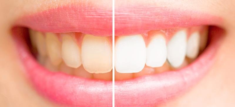 What Is The Impact Of Coffee And Tea On Teeth Staining?