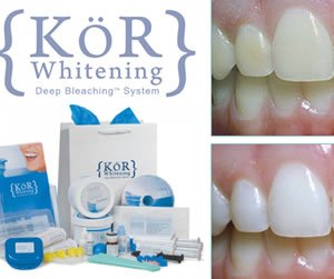 What Is The KöR Whitening System?