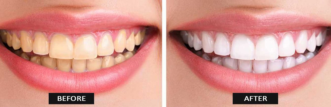 Whats The Average Time It Takes To See Results From Teeth Whitening?