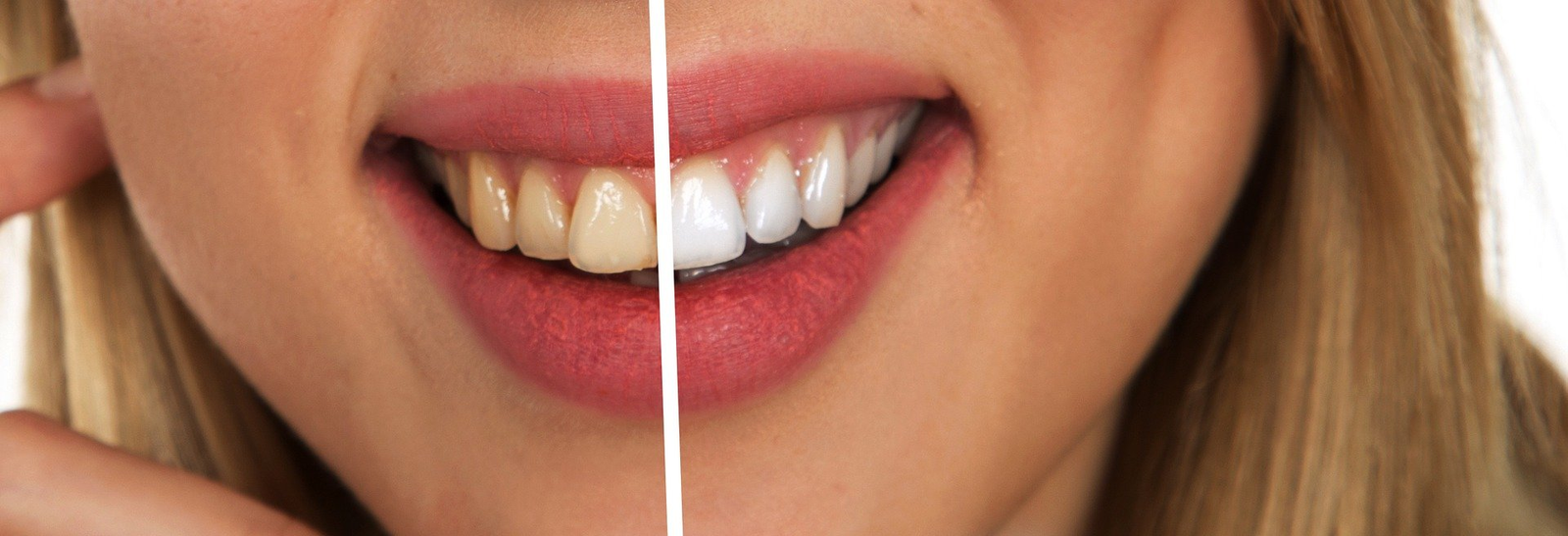 Whats The Average Time It Takes To See Results From Teeth Whitening?